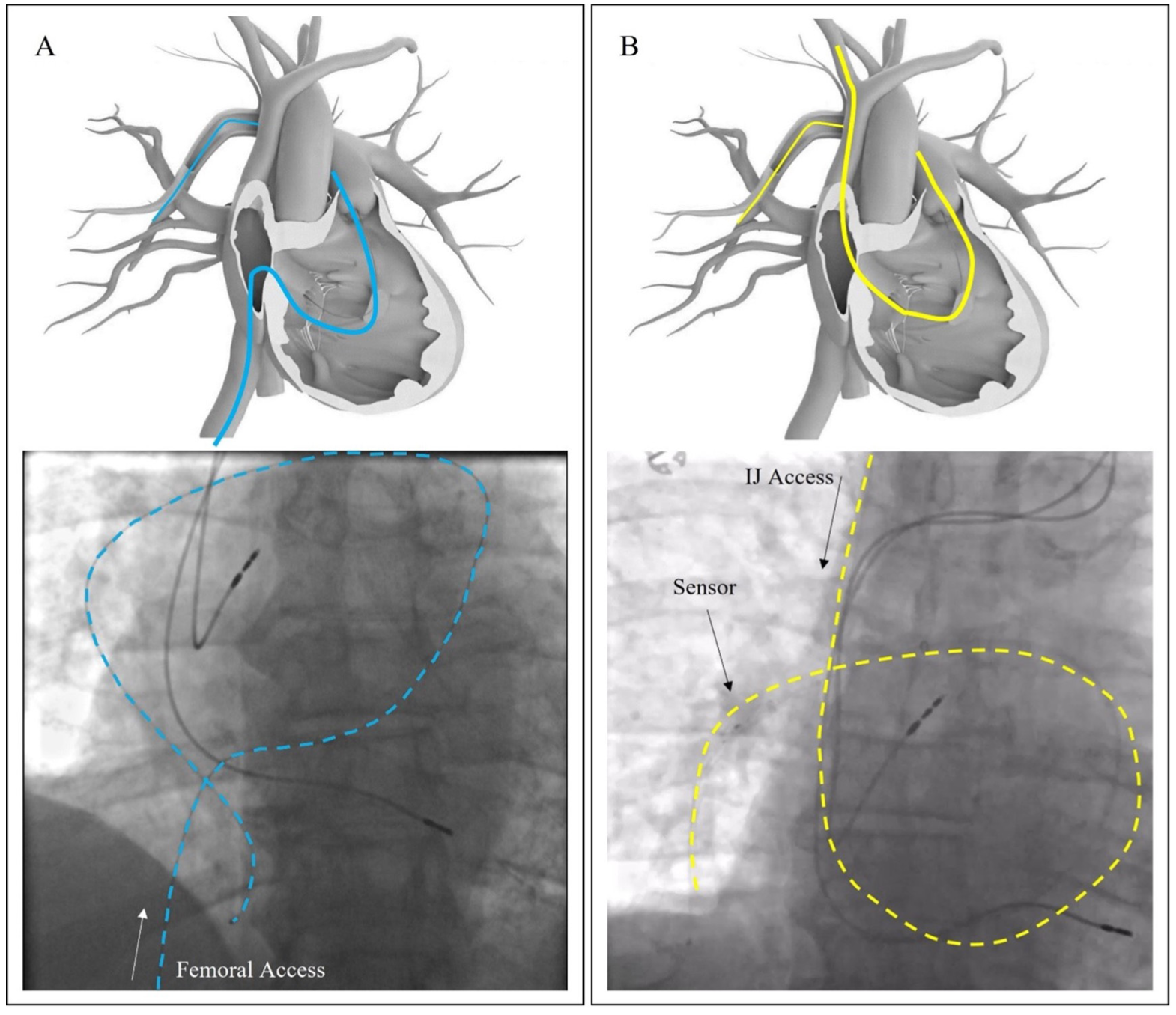 Guide for Implanting the Cordella Pulmonary Artery Pressure Sensor